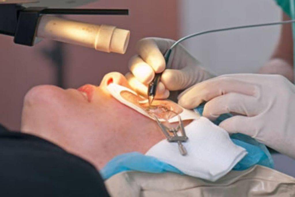 Common surgical eye procedures LASIK, Cataract